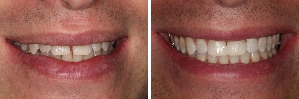 A man's teeth before and after teeth whitening.