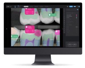 A dental X-ray displayed on a computer monitor with AI-generated overlays identifying areas of caries progression and calculus on multiple teeth.