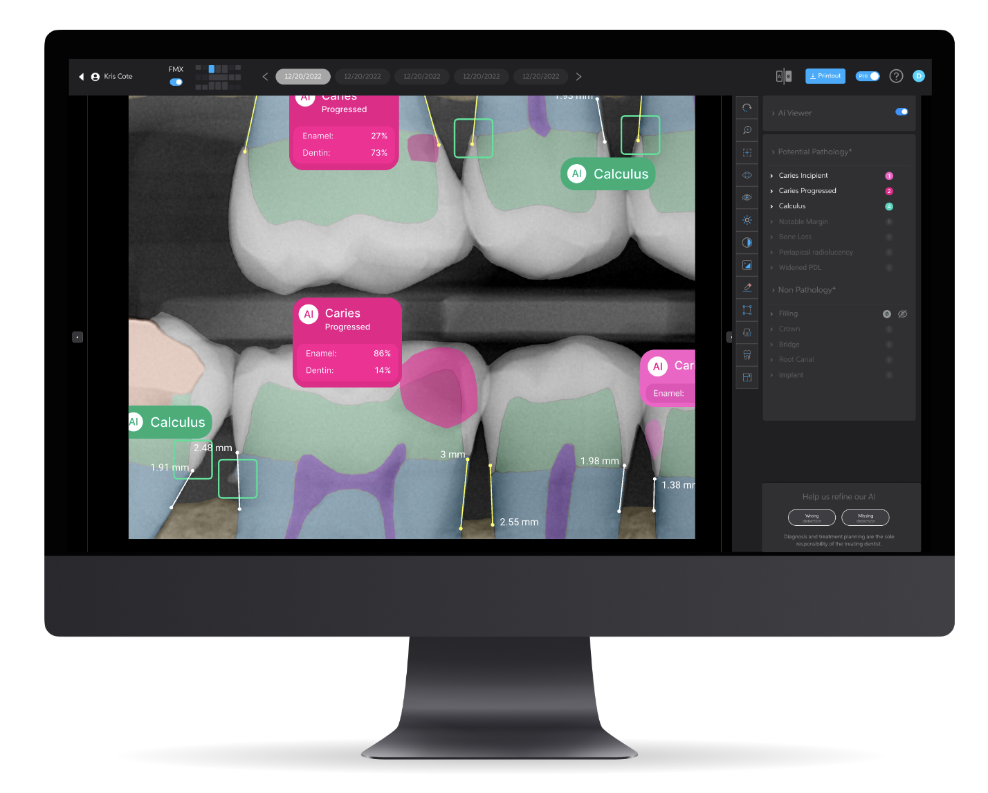A dental X-ray displayed on a computer monitor with AI-generated overlays identifying areas of caries progression and calculus on multiple teeth.