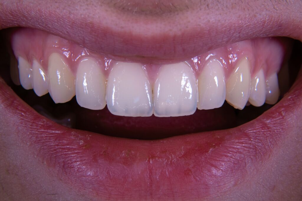 Close-up of a person smiling, showing clean, white upper and lower teeth and healthy gums.