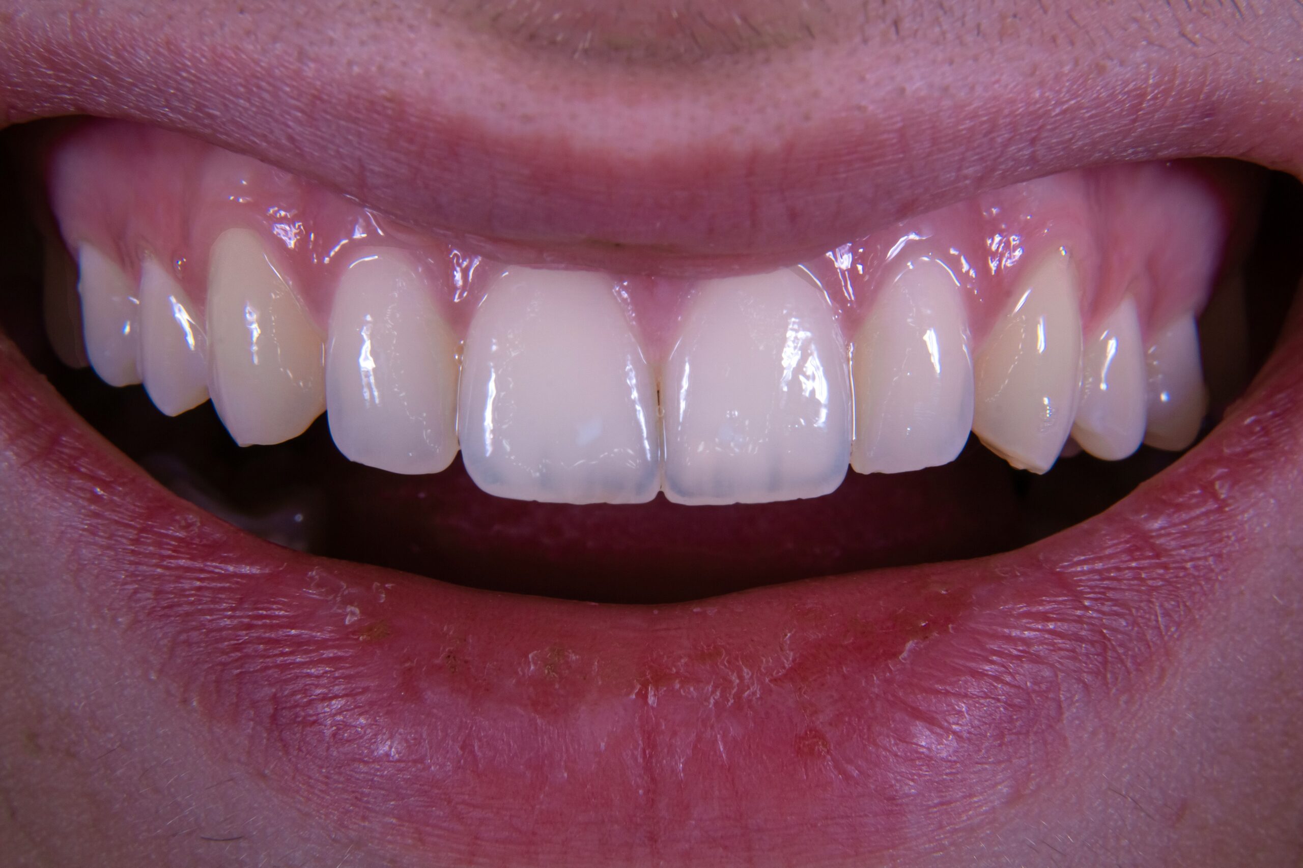 Close-up of a person smiling, showing clean, white upper and lower teeth and healthy gums.