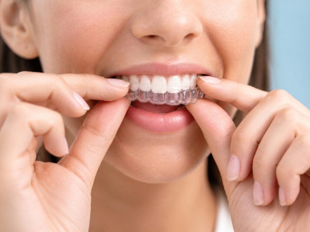 A person is placing a clear dental aligner over their upper teeth, using both hands.